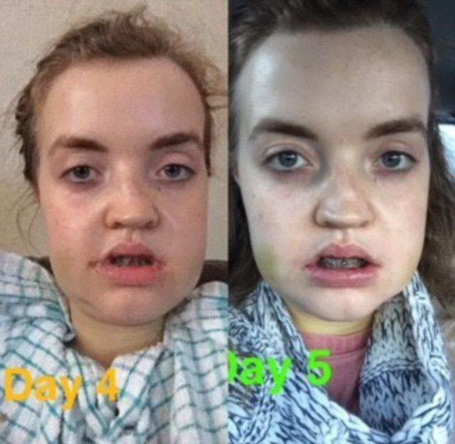 6 18 Itt a bizonyíték, hogy a plasztikai sebészet csodákra képes! Ennek a lánynak borzalmas élete volt amíg meg nem műtötték.