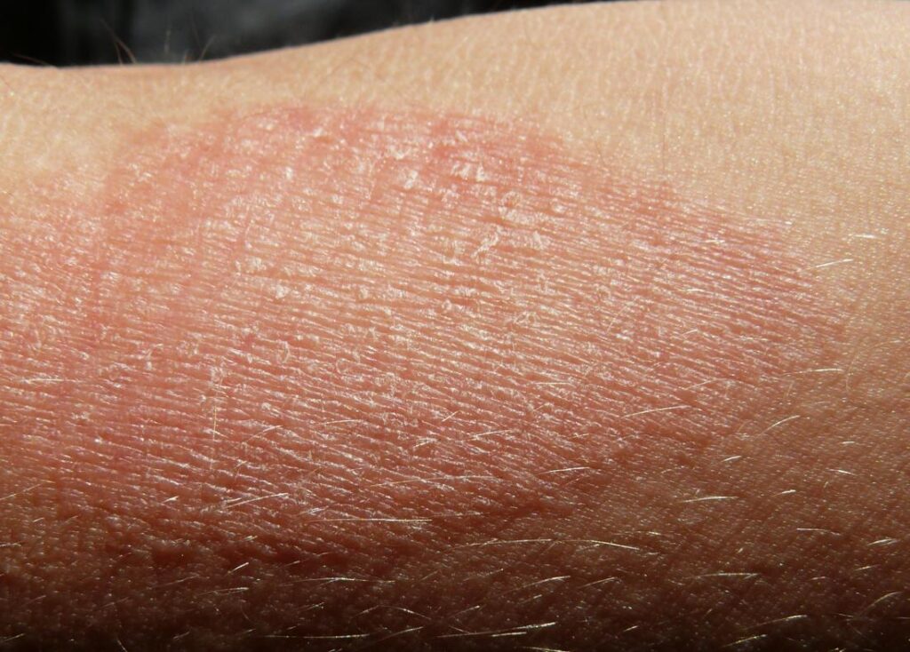 atopic dermatitis image credit g steph rocket 2015 1 8 jel, amikor a viszketés egy komoly figyelmeztetés a testünktől