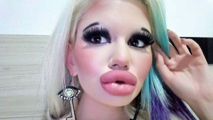 011 Ez a fiatal nő a világ legnagyobb ajkaira vágyik - Így nézett ki a plasztikai műtétek előtt
