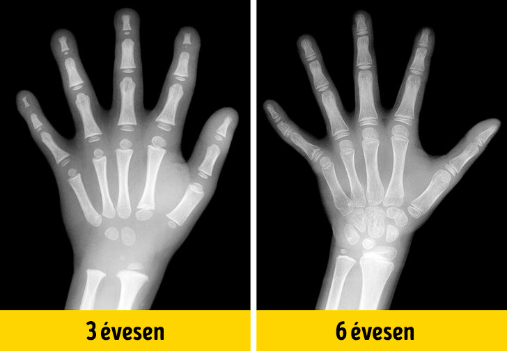 Gyermek kezenek valtozasa 16 különleges röntgenkép, amely eddig rejtve volt előttünk, de a radiológusok most lerántották a leplet