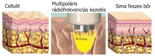 4 32 5 módszer, mellyel szakemberek szerint csökkenteni lehet a testen lévő narancsbőrt