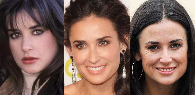 demi moore plastic surgery before and after photos Íme néhány híres nő, aki plasztikai műtéttel változtatott megjelenésén