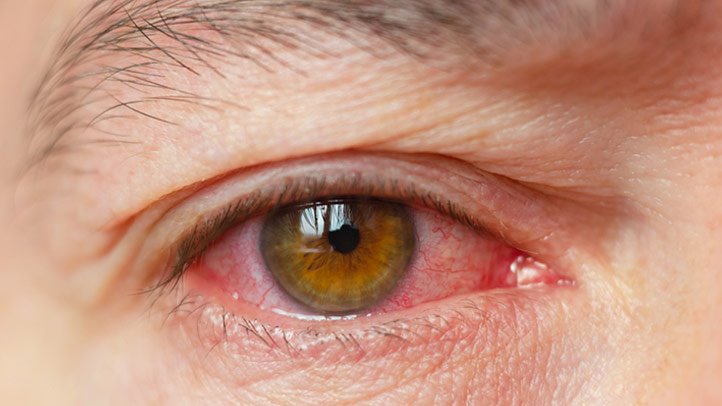 What Is Dry Eye Symptoms Treatment Causes Újabb szokatlan tünetet azonosítottak - A koronavírusról árulkodik a szemünk is