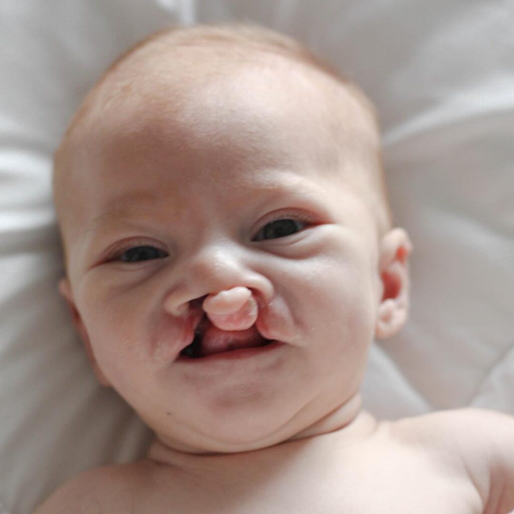 4 45 Az orvosok azt tanácsolták nekik, hogy vetessék el a deformitással rendelkező kisbabát - Így néz ki napjainkban a kisfiú