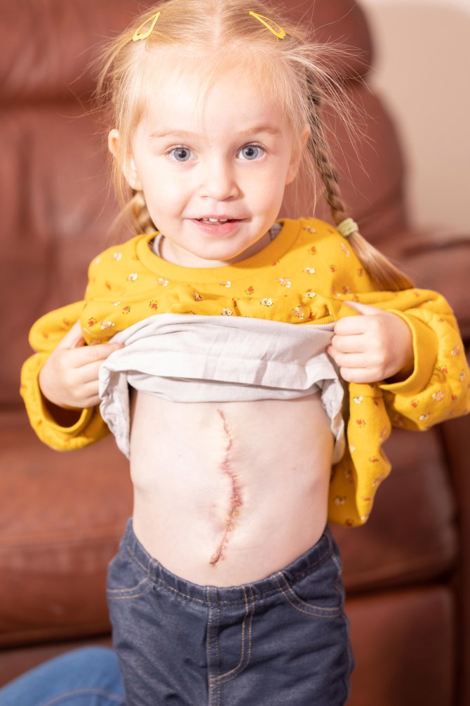 1 23 Belső szerveivel a testén kívül született - 3 évesen életmentő műtéten esett át a kislány. Nézd meg, hogy éli a mindennapjait!