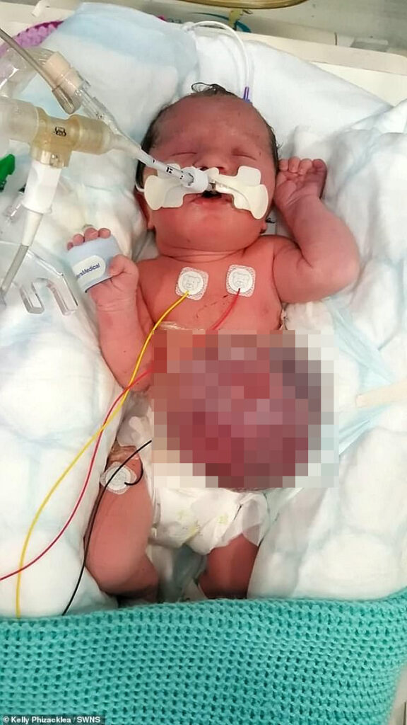 5 18 Belső szerveivel a testén kívül született - 3 évesen életmentő műtéten esett át a kislány. Nézd meg, hogy éli a mindennapjait!