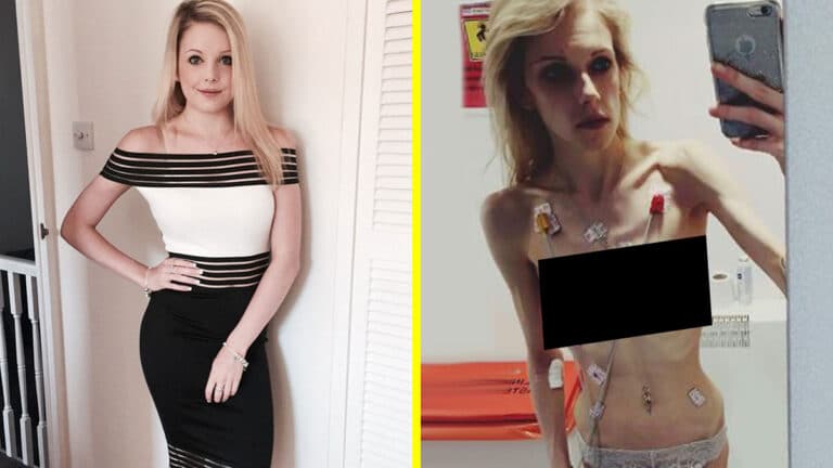 „Az Instagram miatt lettem anorexiás.” 30 kilóra fogyott a fiatal lány