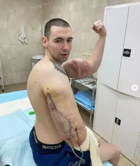 Wstrzykiwal trucizne w bicepsy 1 Az orosz katona mérgeket fecskendezett a bicepszébe, hogy nagyobb legyen. Most amputálni kell a karjait