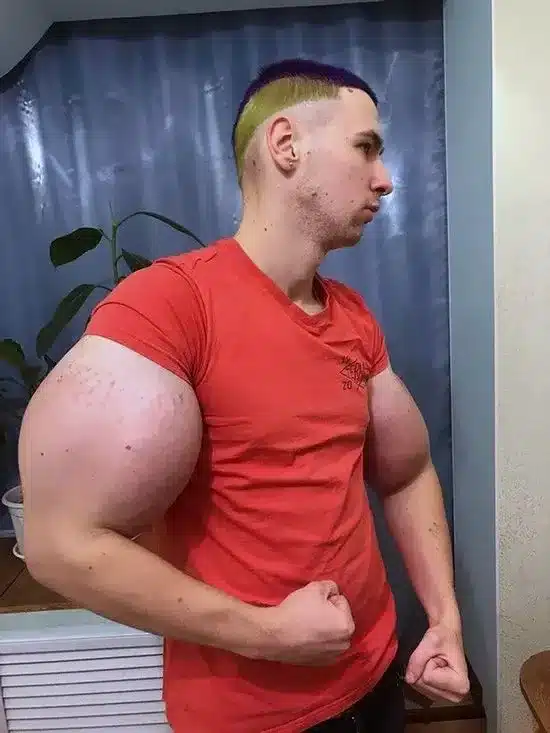 kirill tereshin 1.jpg Az orosz katona mérgeket fecskendezett a bicepszébe, hogy nagyobb legyen. Most amputálni kell a karjait