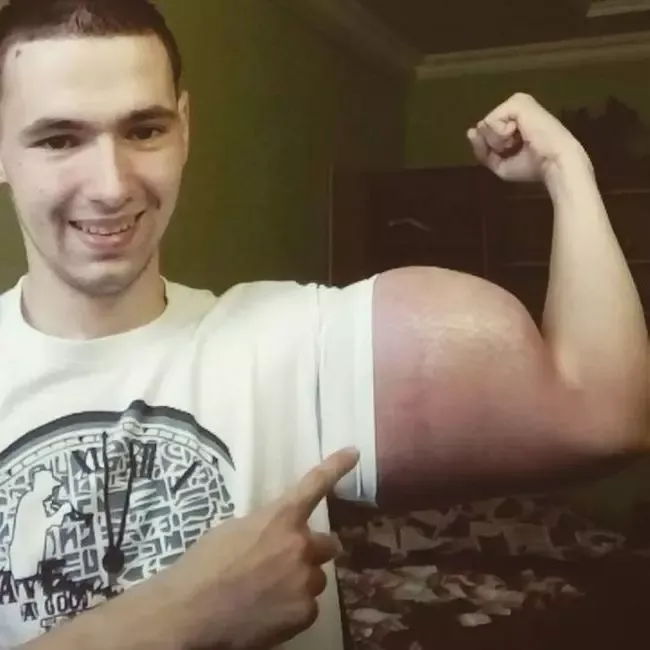 kirill tereshin 3.jpg Az orosz katona mérgeket fecskendezett a bicepszébe, hogy nagyobb legyen. Most amputálni kell a karjait