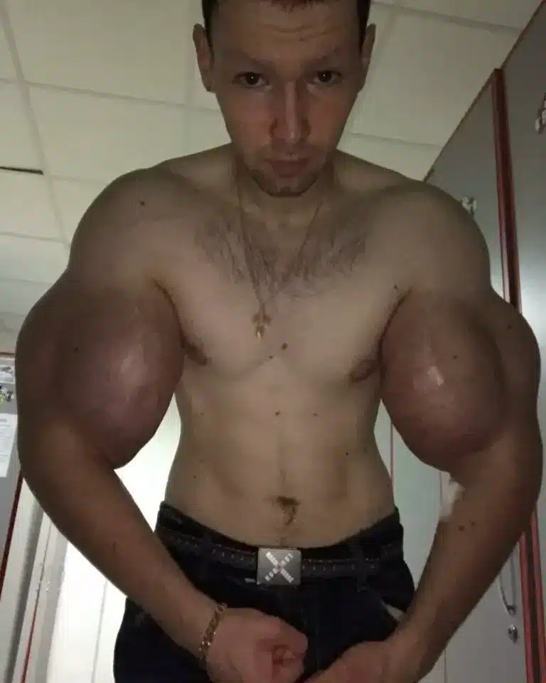 wstrzykiwal trucizne w bicepsy 1 2 Az orosz katona mérgeket fecskendezett a bicepszébe, hogy nagyobb legyen. Most amputálni kell a karjait