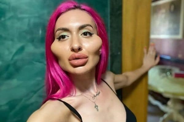 kep 2022 05 01 083931473 MEGÉRTE? A szétműtött arcú ukrán lány most újabb kezeléseket csináltatott.