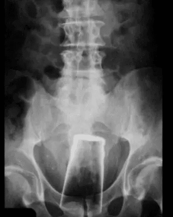 kep 2022 10 25 100104025 14 ritka röntgenfelvétel, amin még az orvosok is kiakadtak. "Fáj, ha rájuk nézek..."