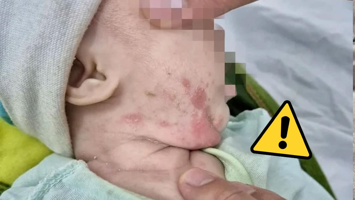 RIASZTÁS! Szifiliszfertőzés söpör végig Magyarországon! Ezek a tünetek: